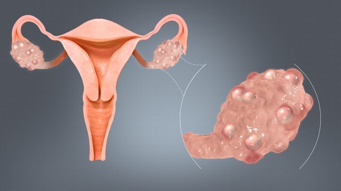 Polycystic Ovarian Syndrome: Symptoms and Treatment
